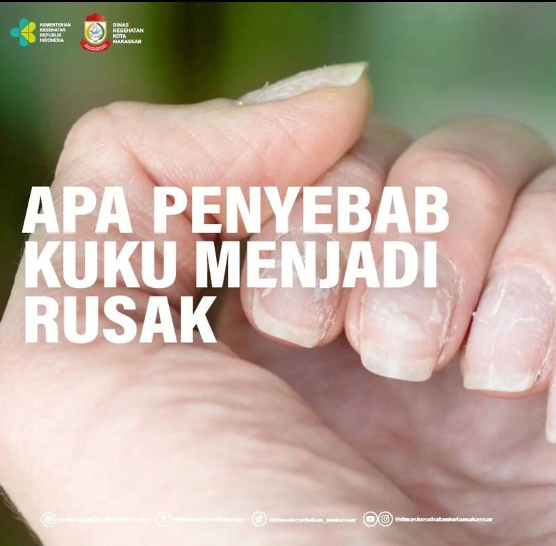 Kuku Rusak, Ini Penyebabnya